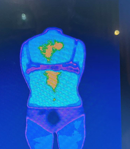 Photo bleutée prise par caméra thermique montrant les zones enflammées en orange sur le dos d’une femme avant la cryothérapie pour soulager les douleurs
